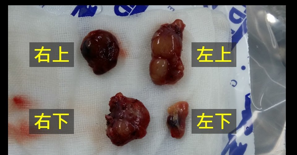 手術中取下的四顆副甲狀腺，放在紗布上並以文字標示右上、左上、右下、左下四個位置