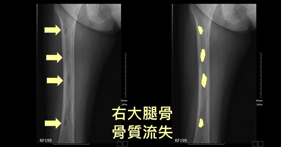 右大腿骨 X 光的兩張對照影像，左圖以箭頭指出骨皮質變薄與骨質流失的位置，右圖以標記標出同樣的病灶範圍