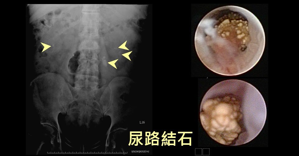 案例二的影像：左側為腹部 X 光，以箭頭指出多顆尿路結石的位置；右側為兩張內視鏡影像，顯示結石的實際外觀