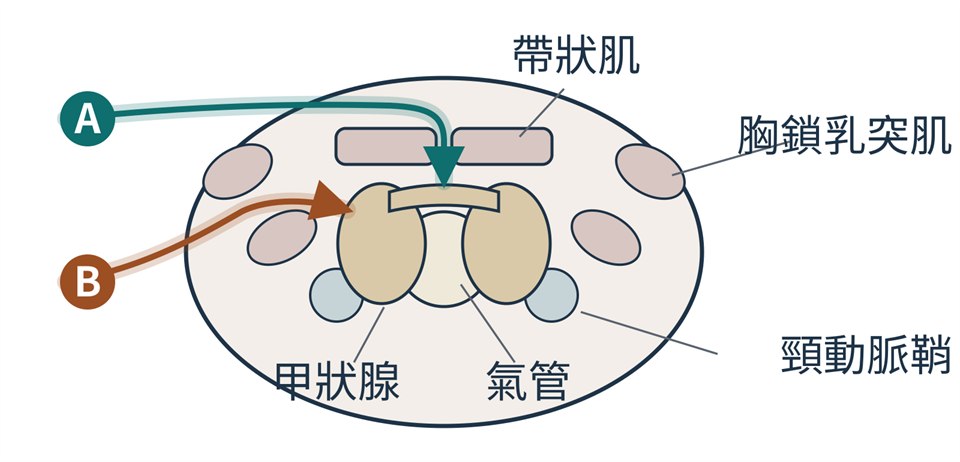 頸部橫切面的示意圖，前方朝上：中央是氣管，兩側是甲狀腺的左右葉與中間的峽部，前方有兩塊帶狀肌、中間留著正中線的縫隙，左右外側各有胸鎖乳突肌的兩個頭與頸動脈鞘。兩條路徑從左側進來：藍綠色的 A 走在帶狀肌上方、到正中線才向下轉進去；赭色的 B 穿過胸鎖乳突肌兩個頭之間，從帶狀肌下方抵達甲狀腺的外側