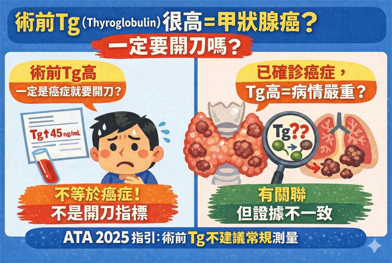 資訊圖，分兩欄回應兩個常見誤解：術前 Tg 高不等於癌症、也不是開刀指標；已確診癌症時 Tg 高與病情有關聯但證據不一致。下方標註 ATA 2025 指引不建議常規測量術前 Tg