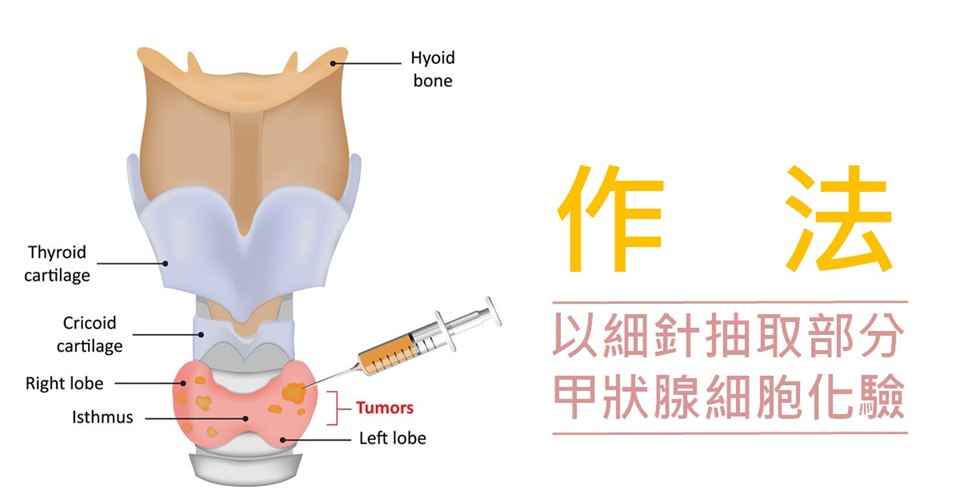 甲狀腺解剖示意圖，標示舌骨、甲狀軟骨、環狀軟骨與甲狀腺左右葉及峽部，並畫出以細針穿入結節抽取細胞的方式