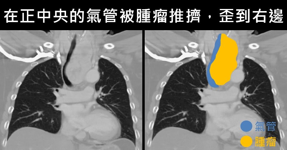 電腦斷層冠狀切面對照圖，右側同一張影像以顏色標示：黃色為左側甲狀腺腫瘤，藍色為氣管，原本位於正中央的氣管被腫瘤推擠而偏向右側