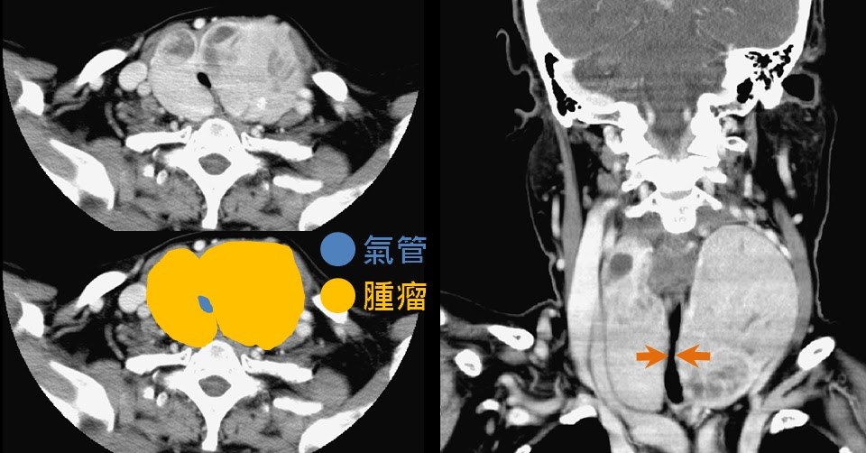 頸部電腦斷層影像，上方為橫切面原圖、下方同一張以黃色標示雙側腫大的甲狀腺，中間氣管的管腔被壓成狹窄的縫隙；右側冠狀切面以箭頭標出氣管受壓的位置