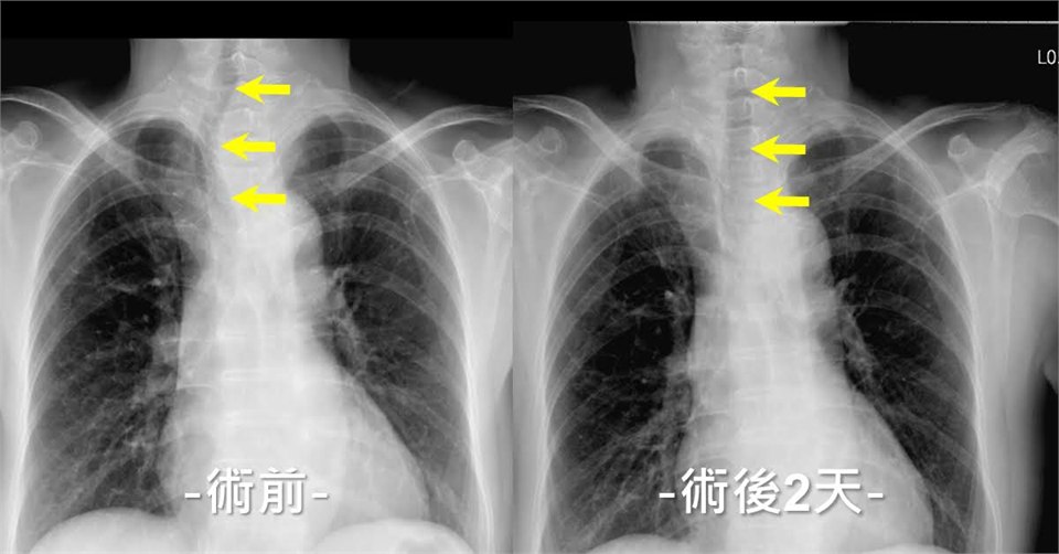 同一位患者的胸部 X 光對照：左為術前，黃色箭頭指出氣管偏向右側；右為術後兩天，同樣位置的氣管已回到接近中線
