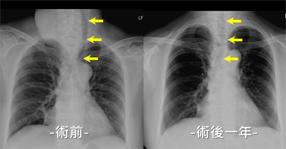 另一位患者的胸部 X 光對照：左為術前，黃色箭頭指出氣管明顯偏移；右為術後一年，氣管位置已回到中線附近